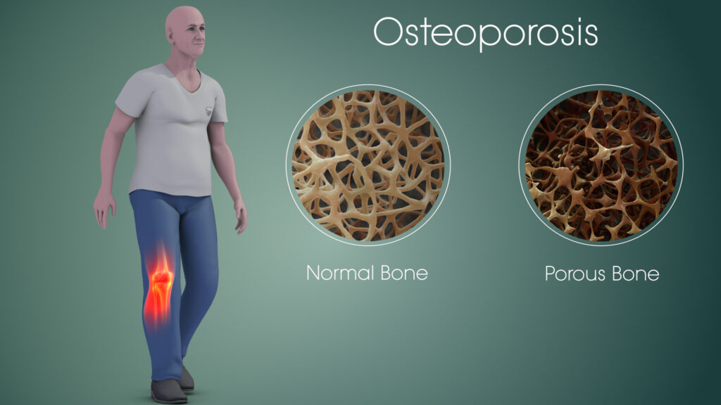 Medical Cannabis Treatment for Osteoporosis